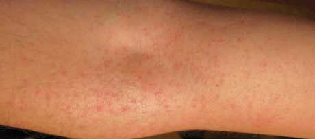 Аллергия на предплечье как сыпь
