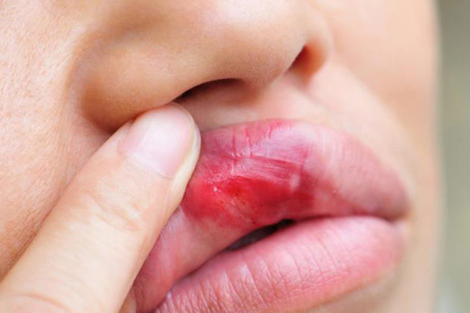 Герпес во рту у взрослых: лечение