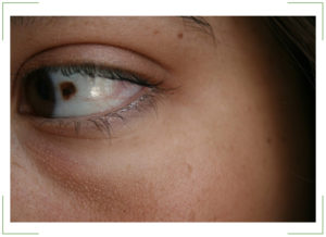 Онкология глаза