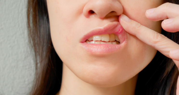 Воспаление слизистой рта