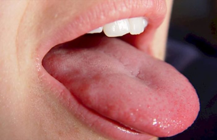 Болит корень языка: какие болезни могут вызывать боли?