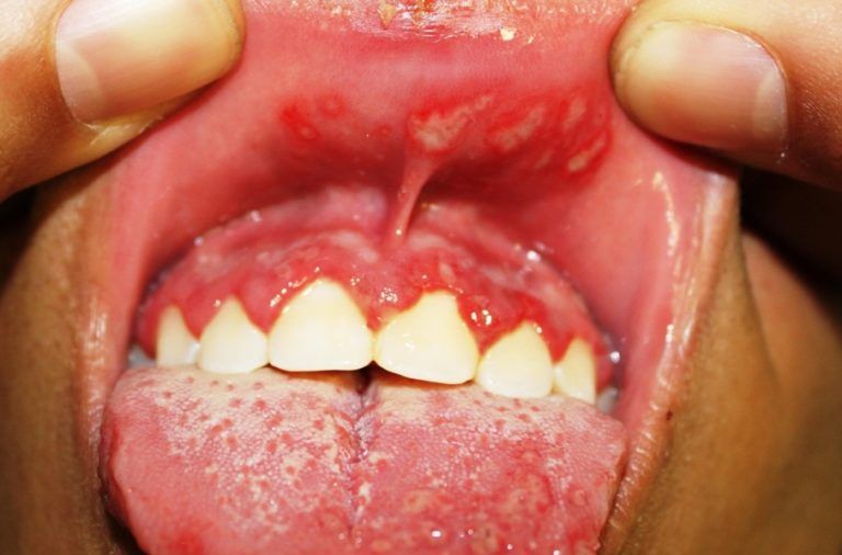 Язва на губе внутри: как лечить