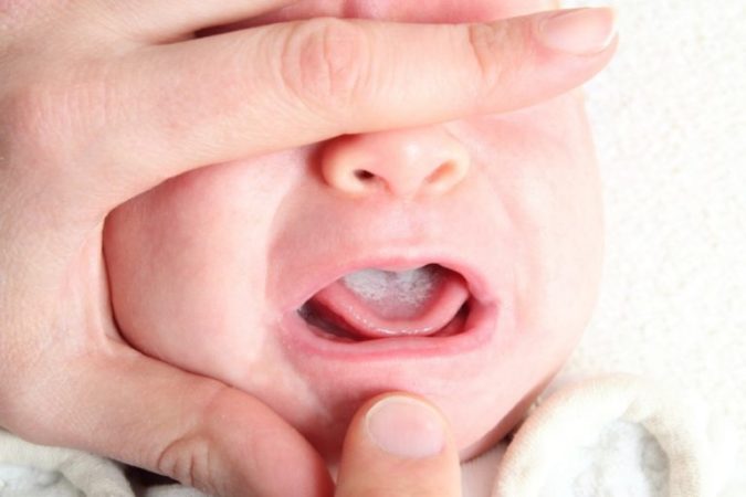 Детский стоматит: симптомы, причины и методы лечения