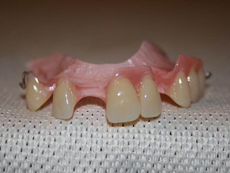 Зубной протез бабочка фото на нижнюю челюсть