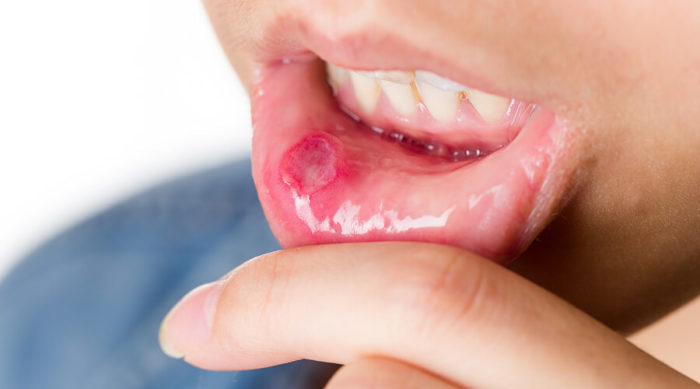 Воспаление слизистой рта