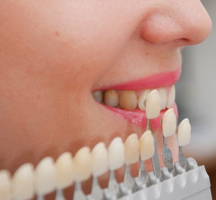 Как выровнять зубы без брекетов
