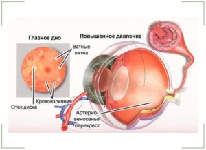 Как лечить глазное давление в домашних условиях