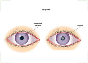 Лазерное лечение катаракты