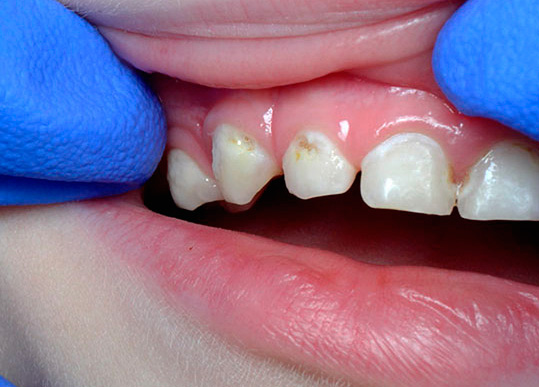 Ставят ли пломбы на молочные зубы
