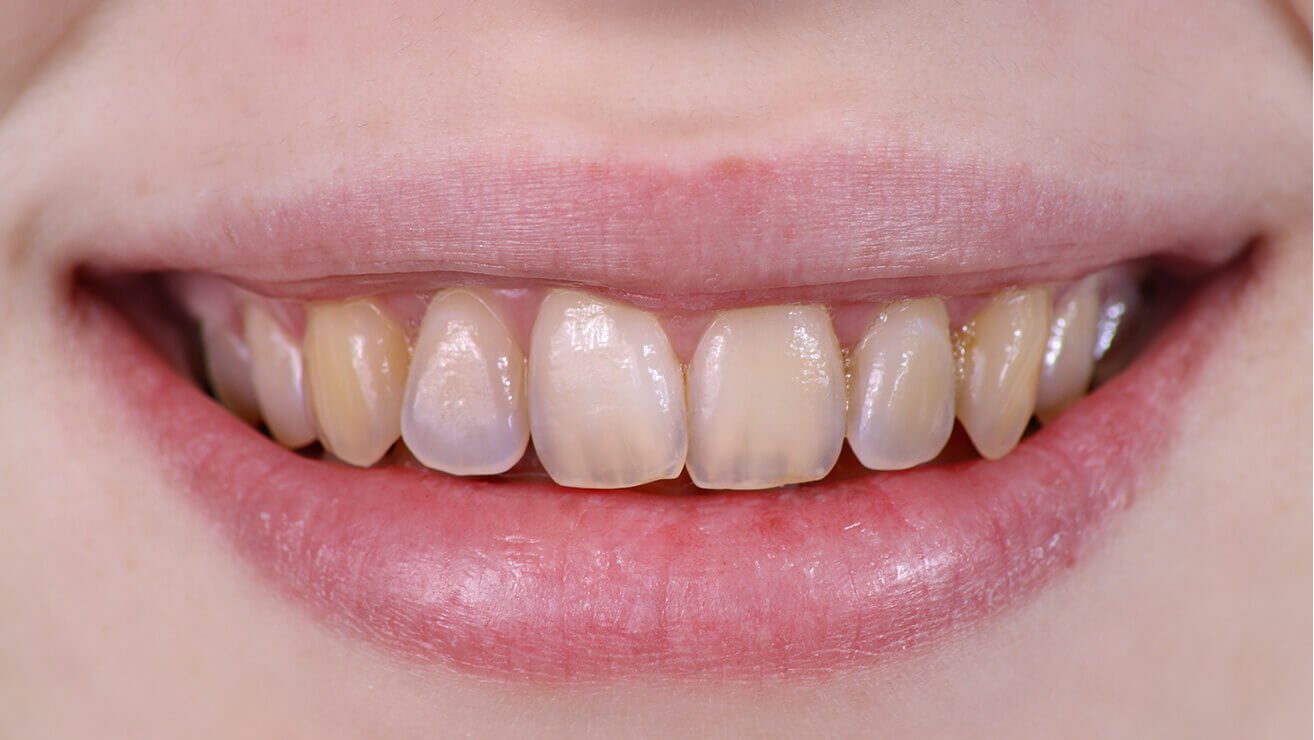 Прозрачные зубы