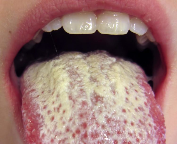Боремся с грибком во рту