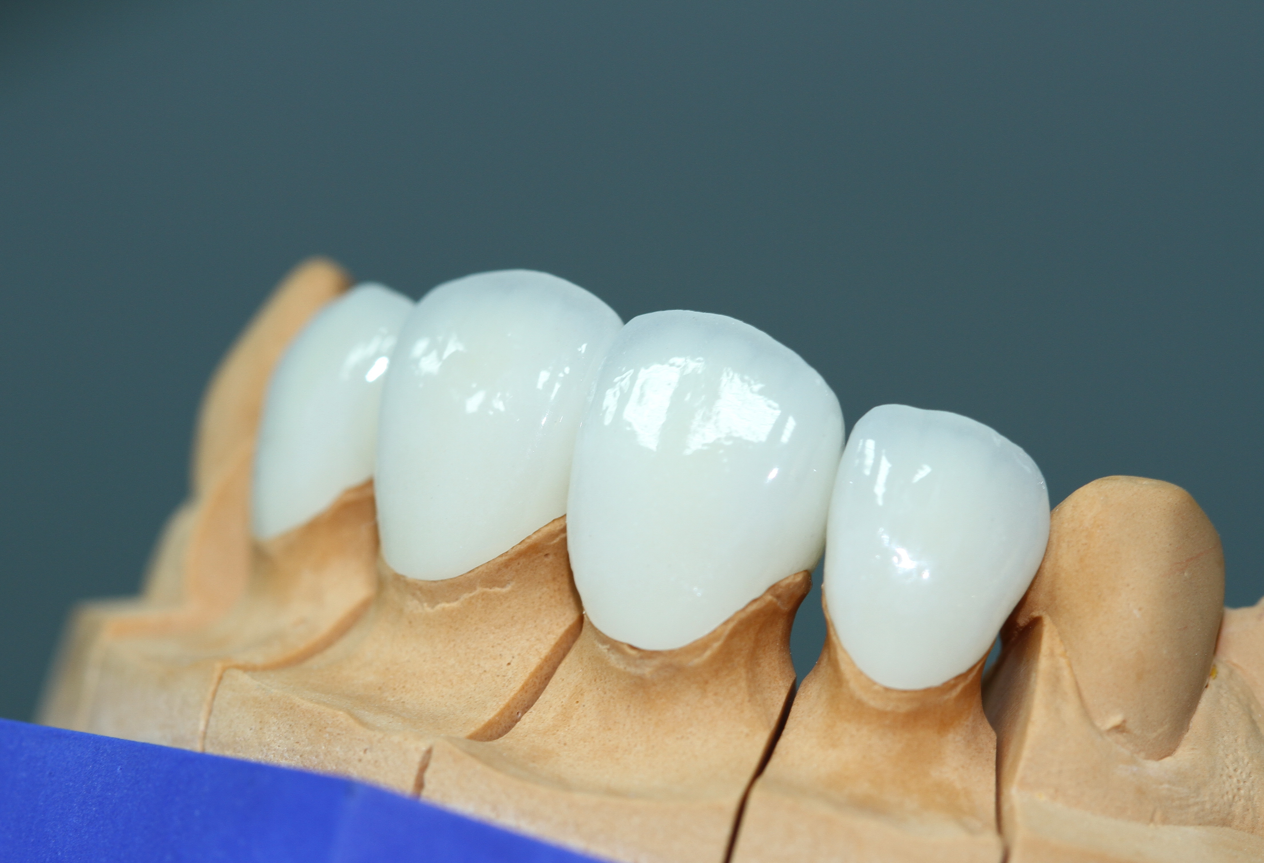 Как выполняется установка виниров на зубы?