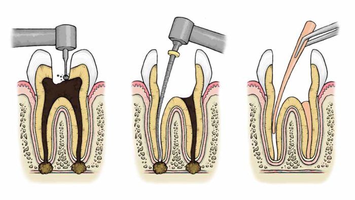 Как пломбируют корневые каналы в зубах