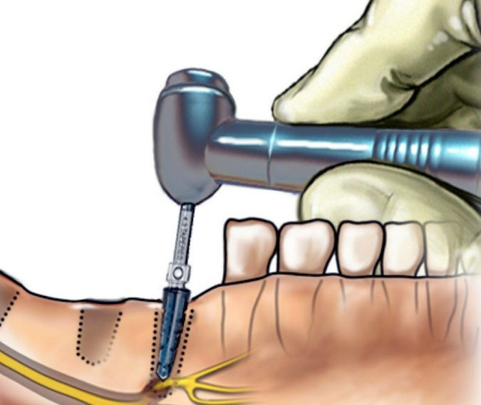 Зубной дренаж в десне