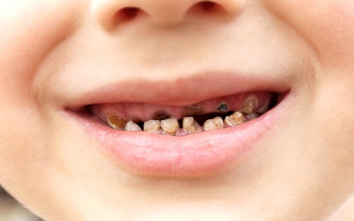 Как избавиться от чёрного налета на зубах у взрослых и детей