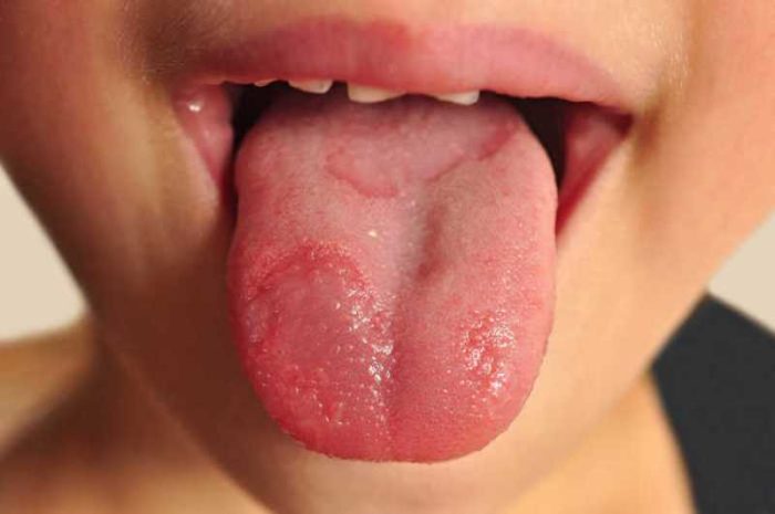 Опасно ли воспаление языка (глоссит)?