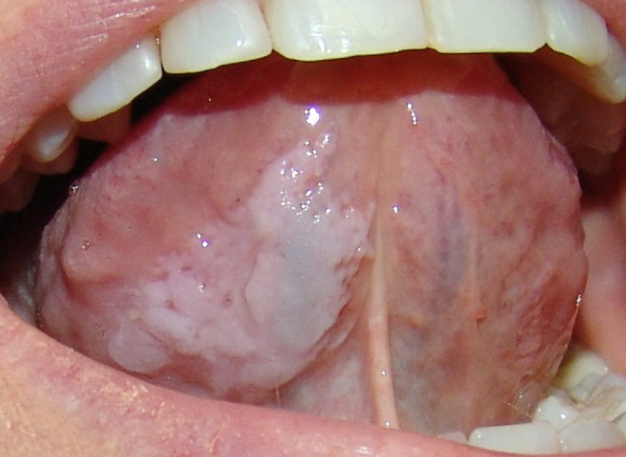 Лейкоплакия полости рта: причины, симптомы, формы патологии