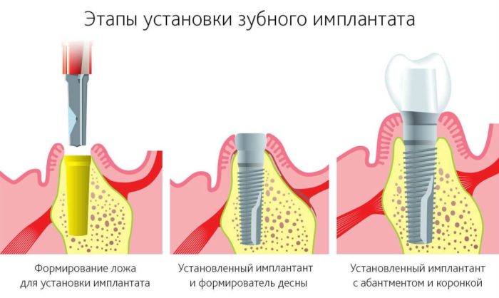 этапы имплантации зуба