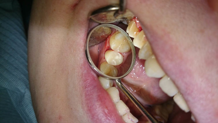 Болит зуб при нажатии на него