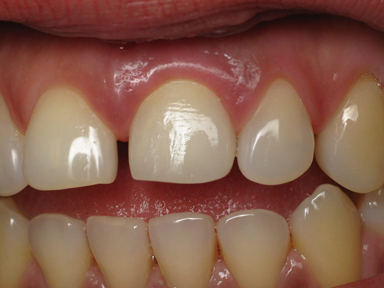 Причины онемения зубов