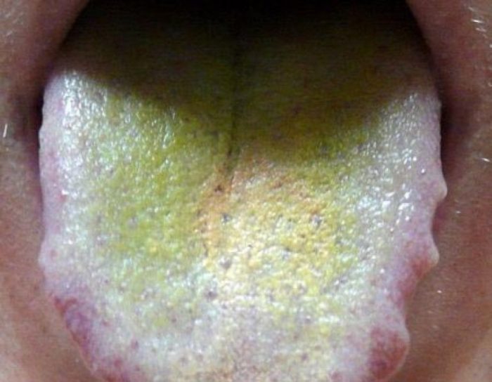 Зеленый налет на языке: симптомы, диагностика, лечение