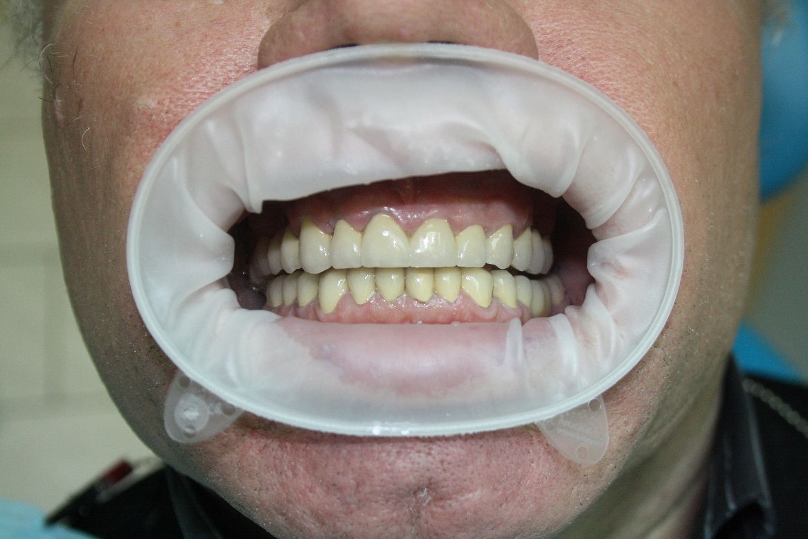 Коронки на зубы металлокерамика фото