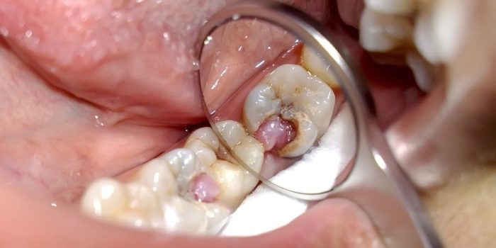 Болит зуб после лечения