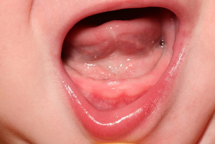 Красное горло при прорезывании зубов
