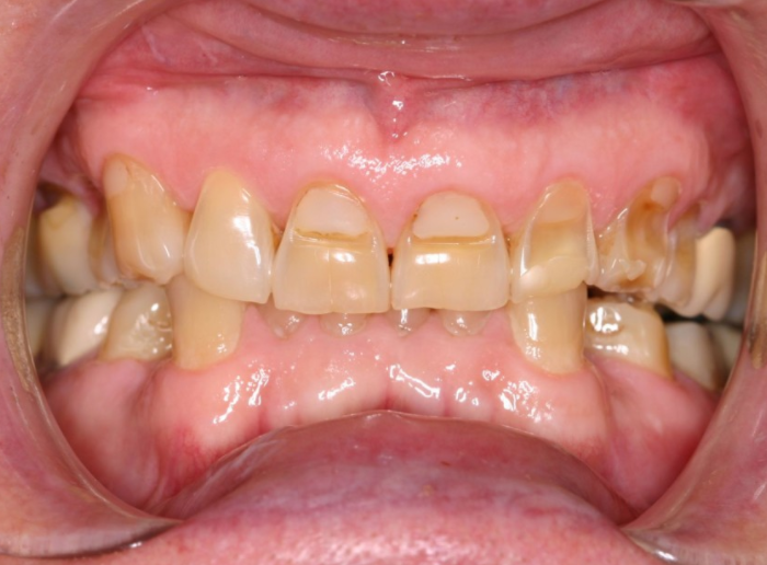 Что такое эрозия эмали зубов?