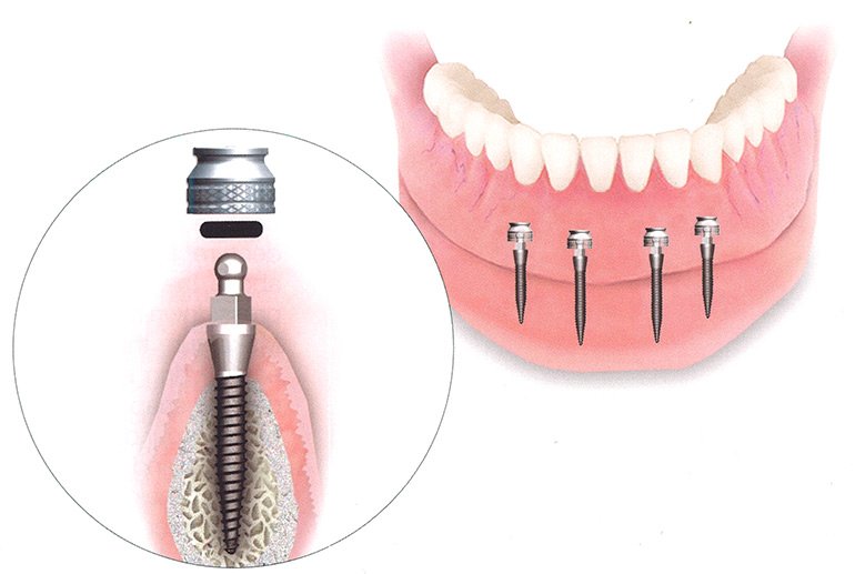 Мини импланты для зубов на верхнюю челюсть