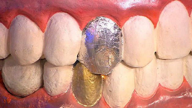 разные металлы в зубах