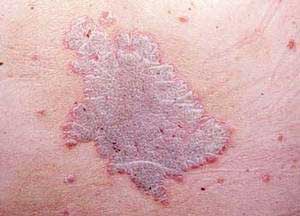 Ихтиоз - причина шелушения кожи