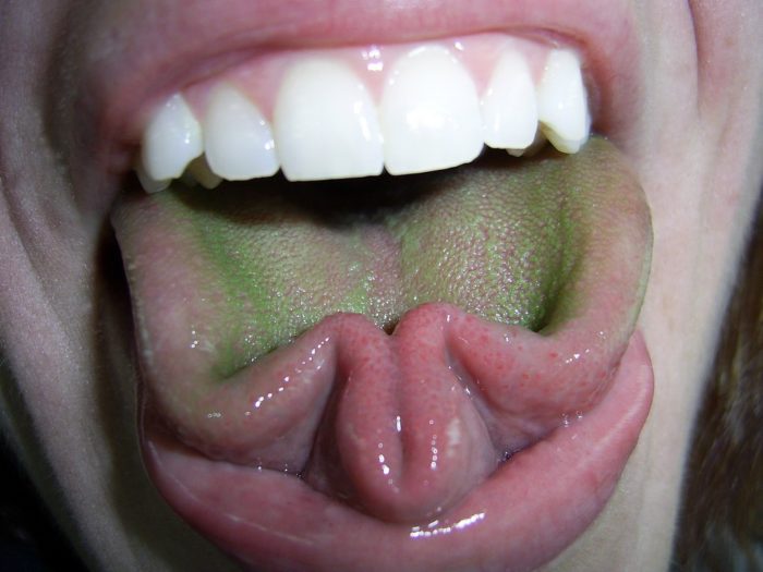 Зеленый налет на языке: симптомы, диагностика, лечение