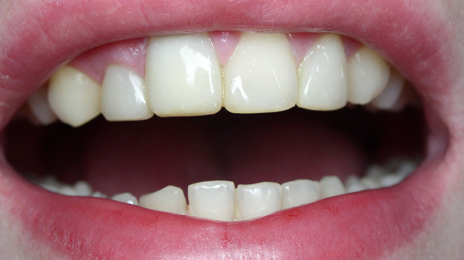 Зубная реставрация. Восстановление передних зубов. Реставрированные передние зубы. Эстетическая реставрация передних зубов.