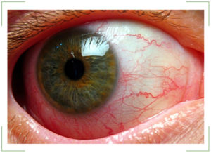 Иридоциклит глаза