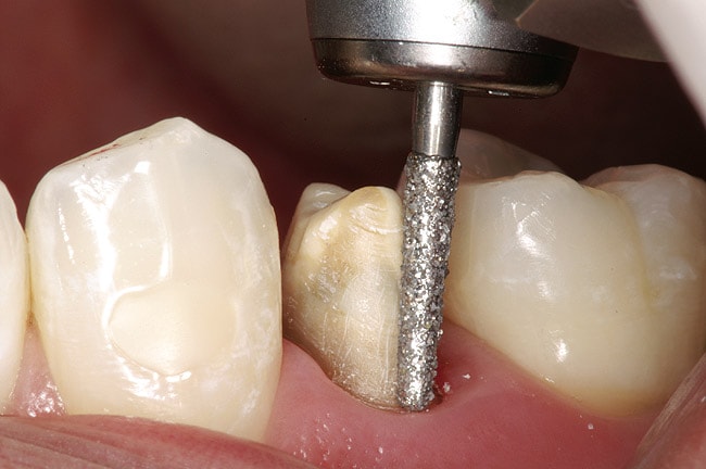 Как проводится установка коронки на зуб