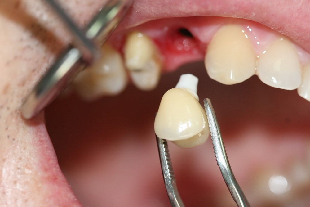 Через какое время после удаления зуба можно делать протезирование?