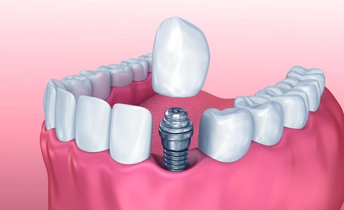 Как происходит имплантация зубов?