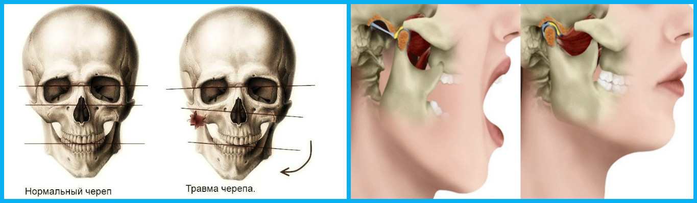 При открытии рта болит ухо. Нижняя челюсть скуловая кость. Вывих височно-нижнечелюстного сустава симптомы.