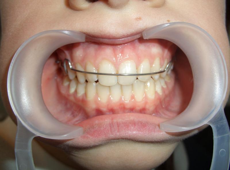 Пластины на зубы: конструкция, преимущества и недостатки, процесс установки