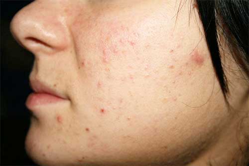 азитромицин воздействует на кожу
