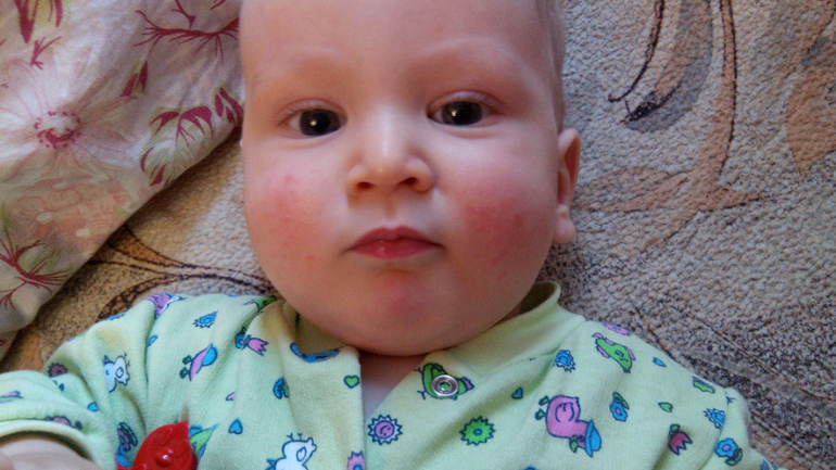 Ребенку год красные щеки. Сыпь на лице при прорезывании зубов.