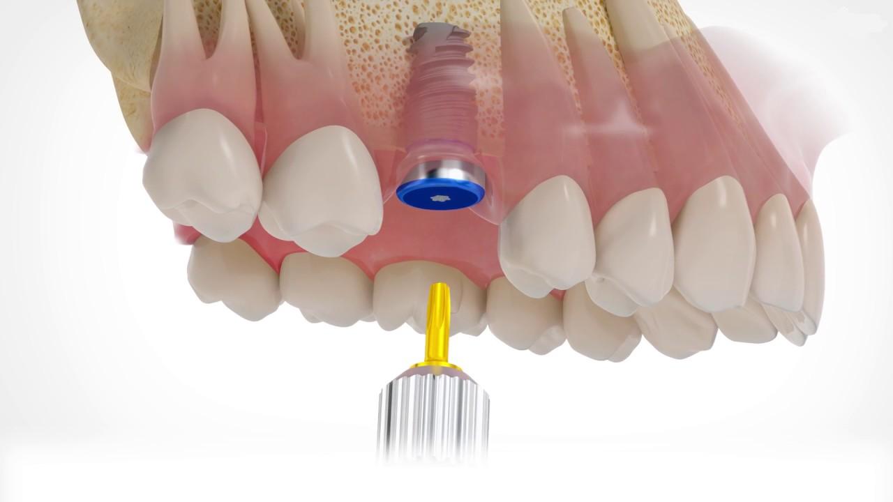имплант зубов