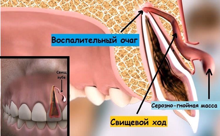 По каким причинам может появиться свищ после удаления зуба?