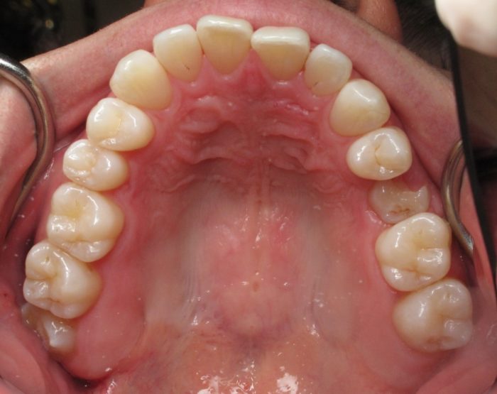 Зуб мудрости растет в щеку: причины, признаки, методы лечения