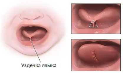 Как делается пластика уздечки языка у детей лазером?