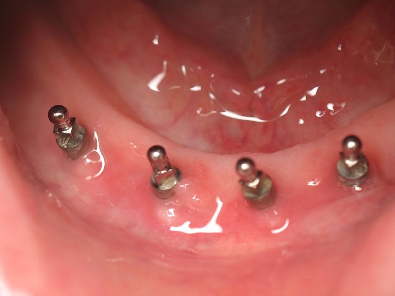 Мини импланты для зубов на верхнюю челюсть