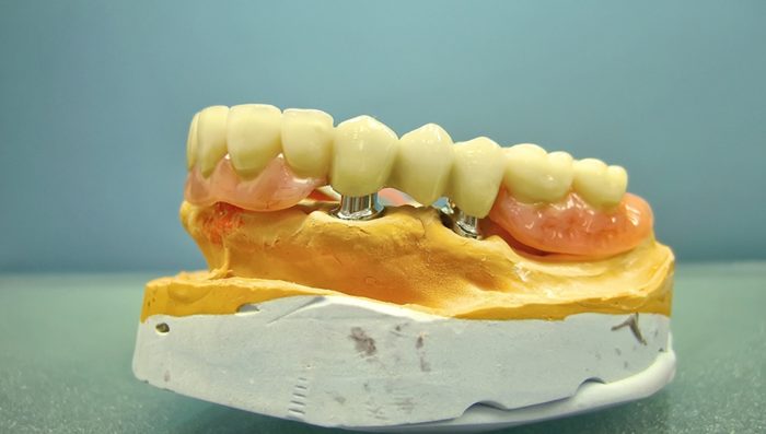 Телескопические зубные протезы