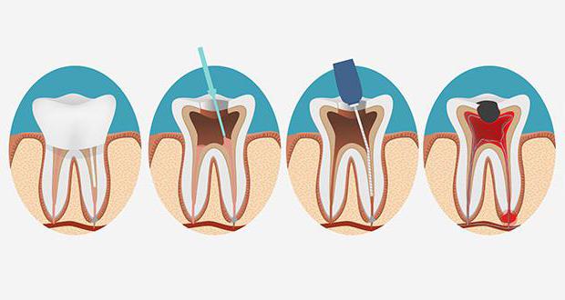 Что такое депульпирование зуба