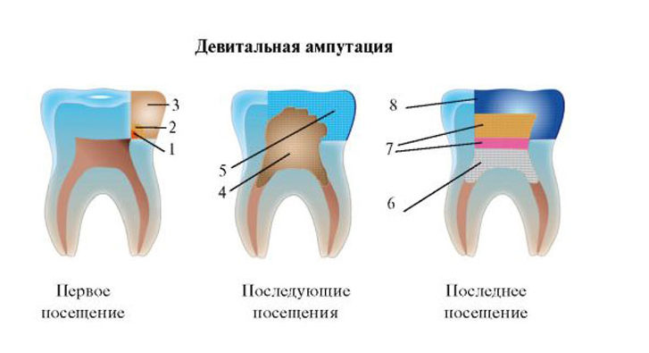 Что такое депульпирование зуба